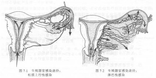 一为沿生殖器官粘膜上行感染,淋病双球菌感染宫颈粘膜,子宫内膜和